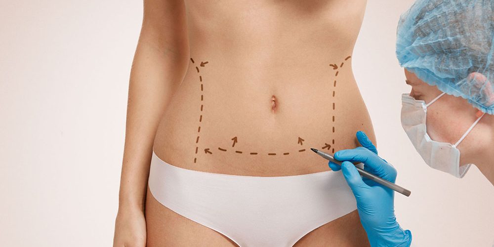 Tummy Tuck - Abdominoplasty - How do I know if I need one? - Flower Mound  Plastic Surgery